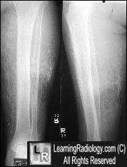 Chr venous insuffiency